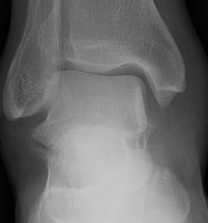 Talus Lateral Process Fracture